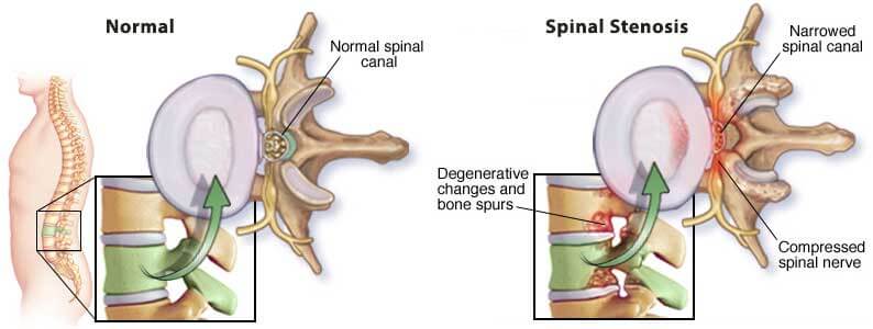 diagram of lumbar spinal stenosis